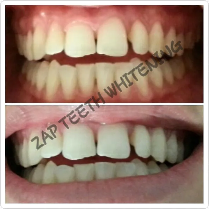 29851 teeth whitening how to