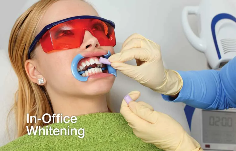 29852 teeth whitening 2