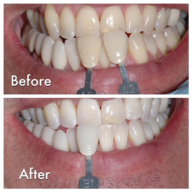29856 laser teeth whitening falkirk procedure