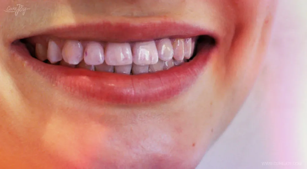 29857 gum irritation