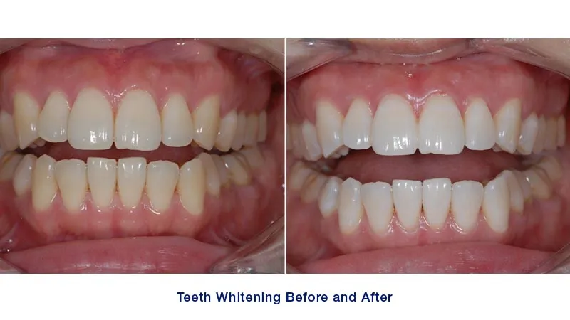 29858 professional whitening