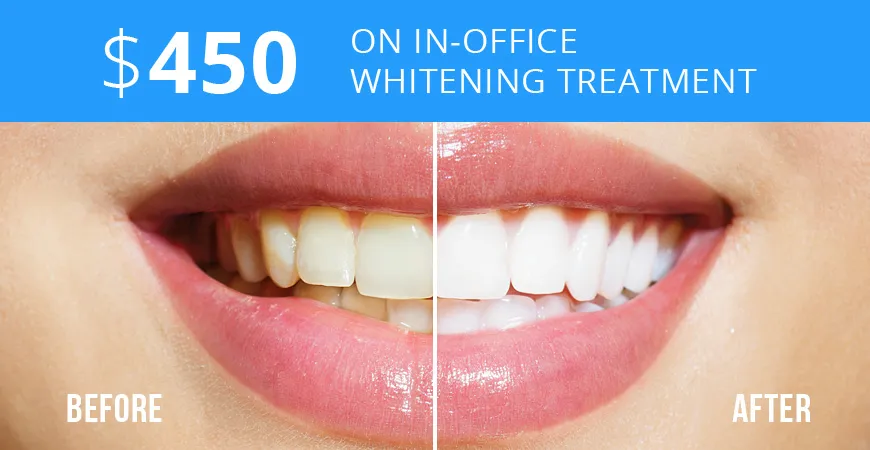 29858 teeth whitening at dentist