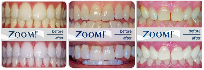 29859 tooth sensitivity after whitening