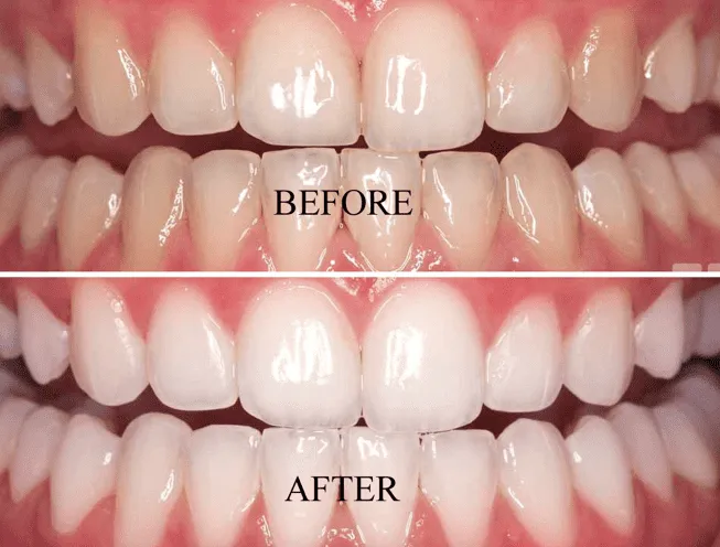 29859 zoom whitening process