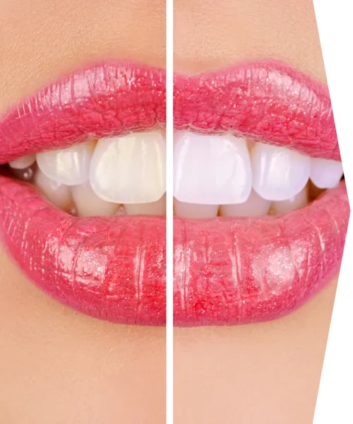 29860 teeth whitening rockford il image2