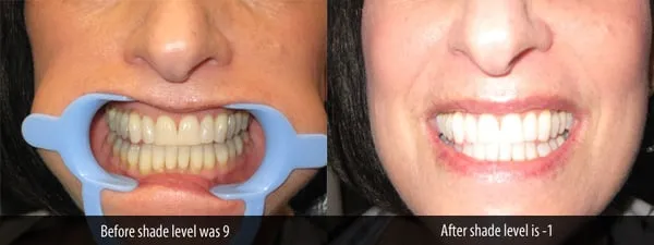 29860 teeth whitening rockford il image4