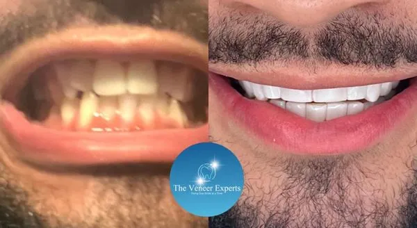 29860 teeth whitening rockford il image5