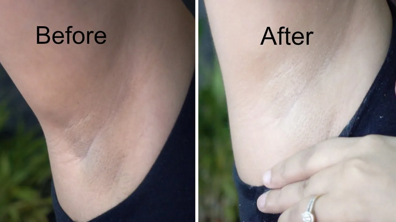 29862 underarm whitening before after