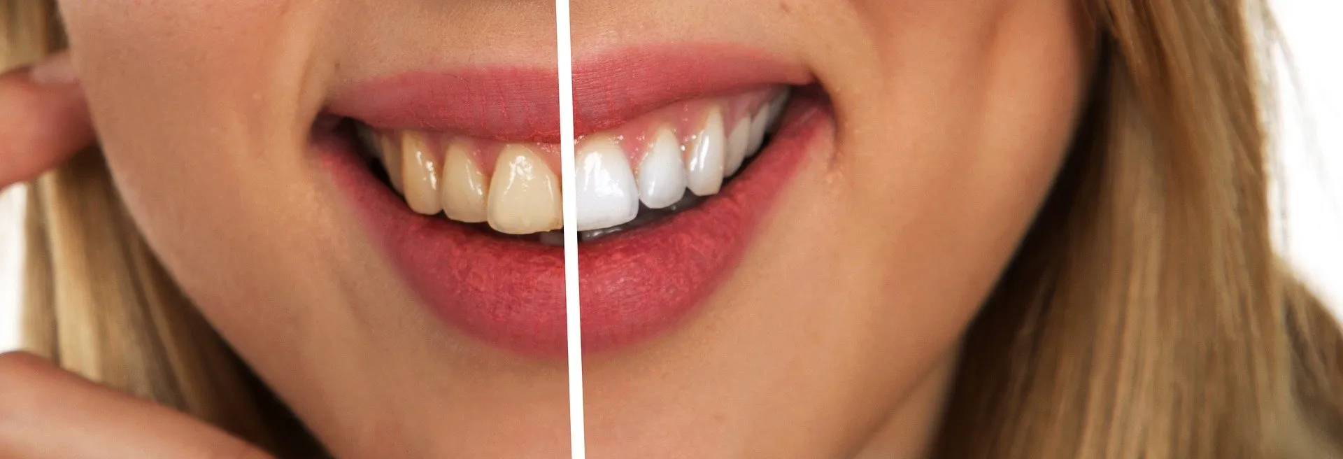 29865 teeth whitening sensitivity 2