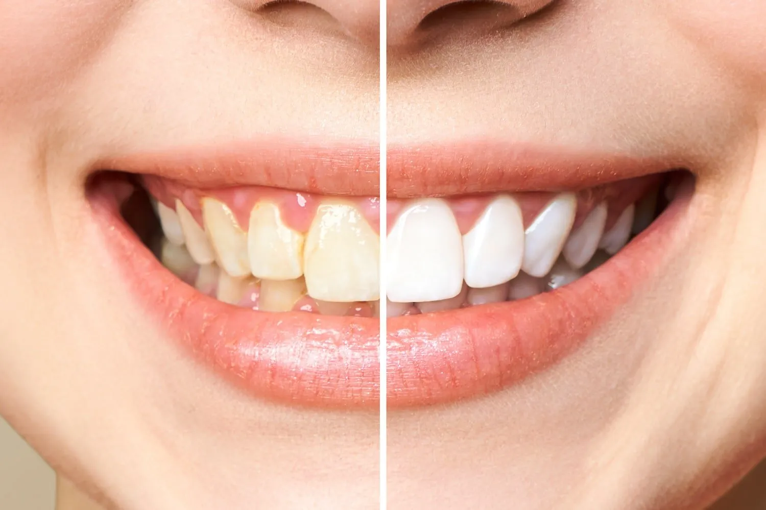 29865 teeth whitening sensitivity 4