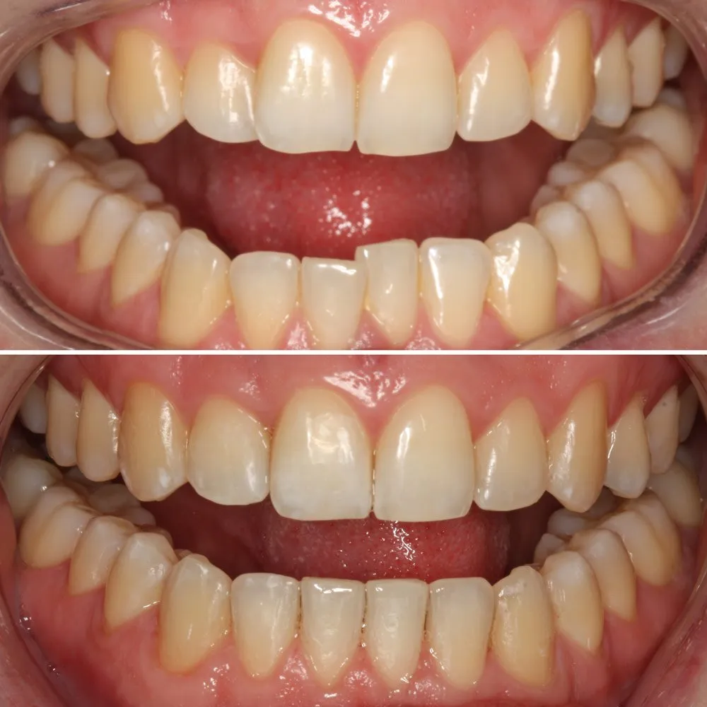 29867 invisalign treatment