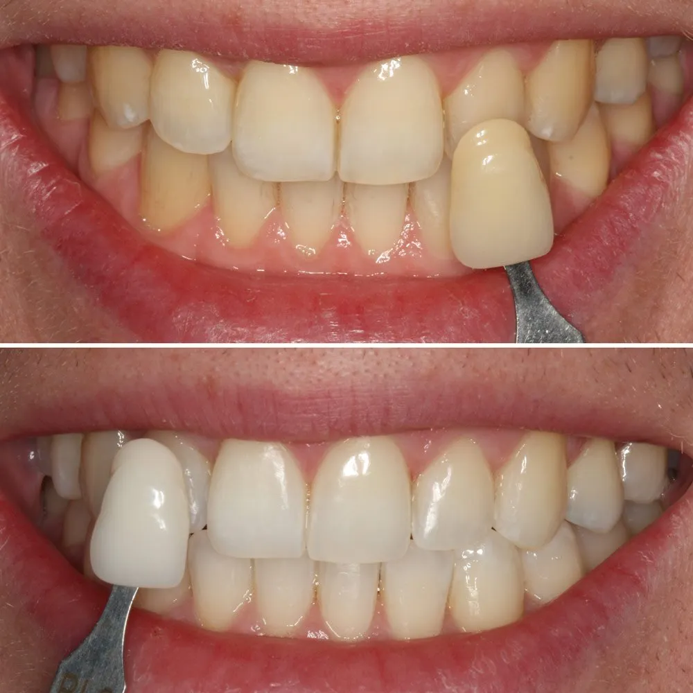 /img/29867-teeth-whitening-process.webp
