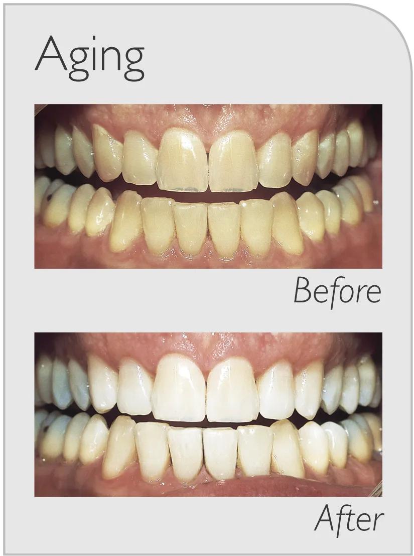 29868 zoom teeth whitening sydney cost