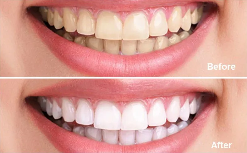 29869 teeth whitening norwood before after
