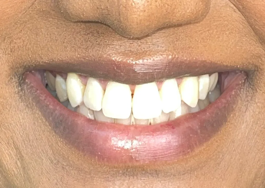 /img/29869-teeth-whitening-norwood-dentist.webp