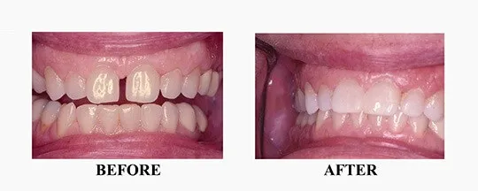 29869 teeth whitening norwood oral hygiene