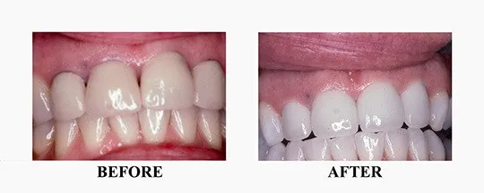 29869 teeth whitening norwood smile