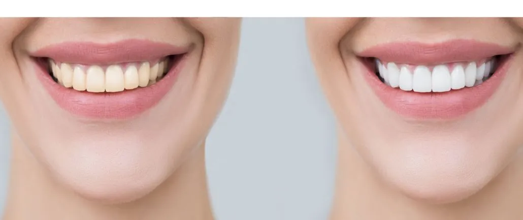 29869 teeth whitening norwood take home