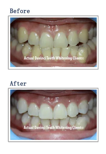 29871 davinci teeth whitening flatirons mall before after