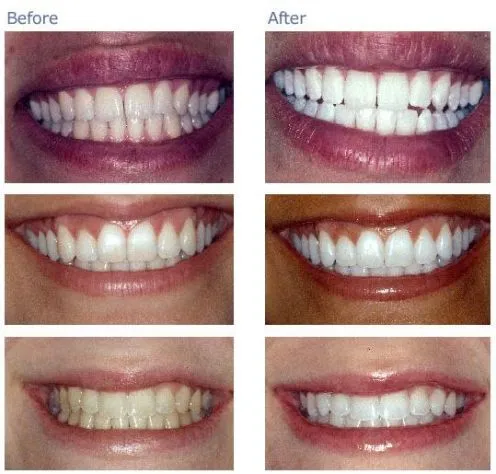 29873 amour noir teeth whitening customer review