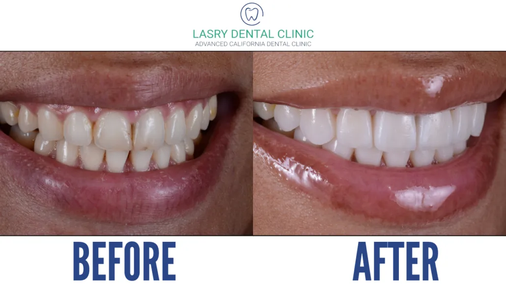 29878 zoom teeth whitening utah dental clinic