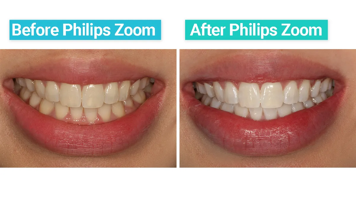 29878 zoom teeth whitening utah patient comfort