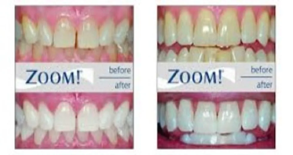 /img/29878-zoom-teeth-whitening-utah-smile.webp