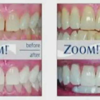 /img/29878-zoom-teeth-whitening-utah-smile.webp