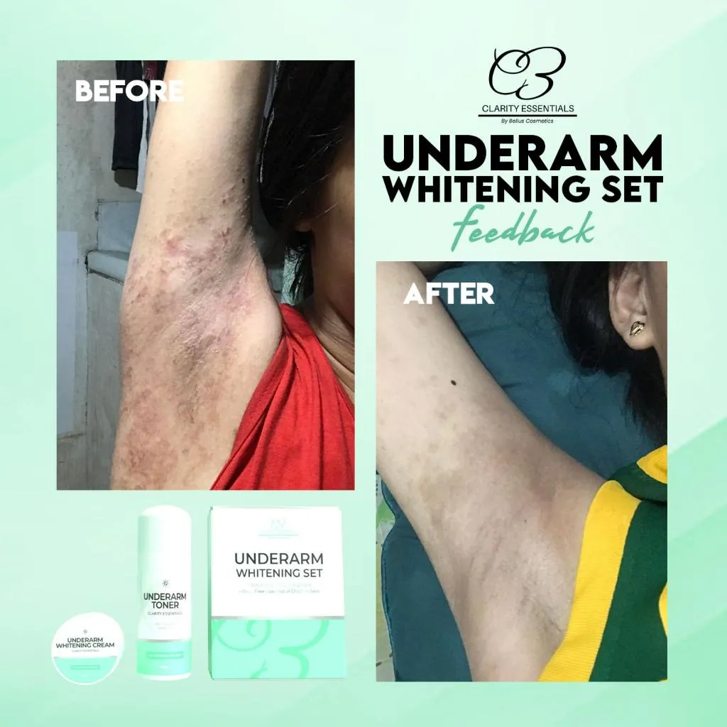 29884 chemical peel underarms