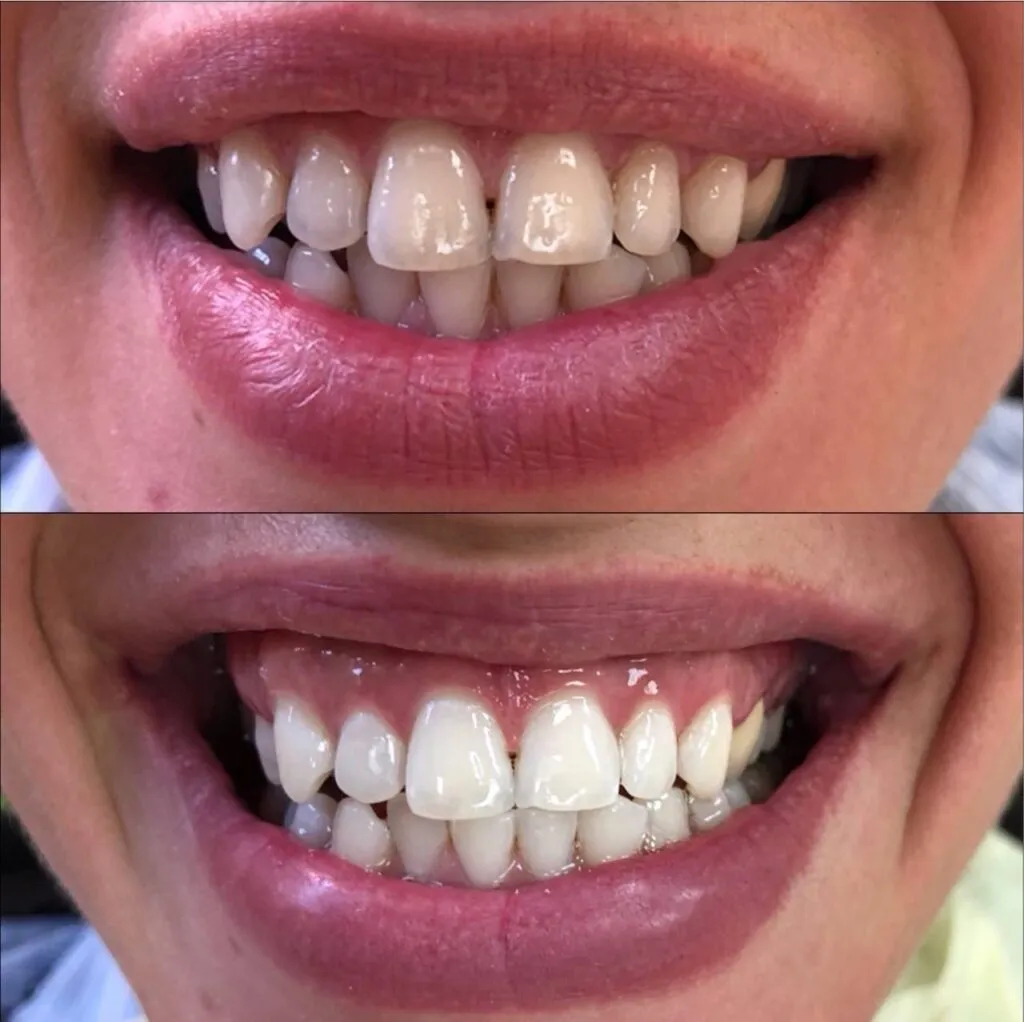29892 miami beach teeth whitening 2