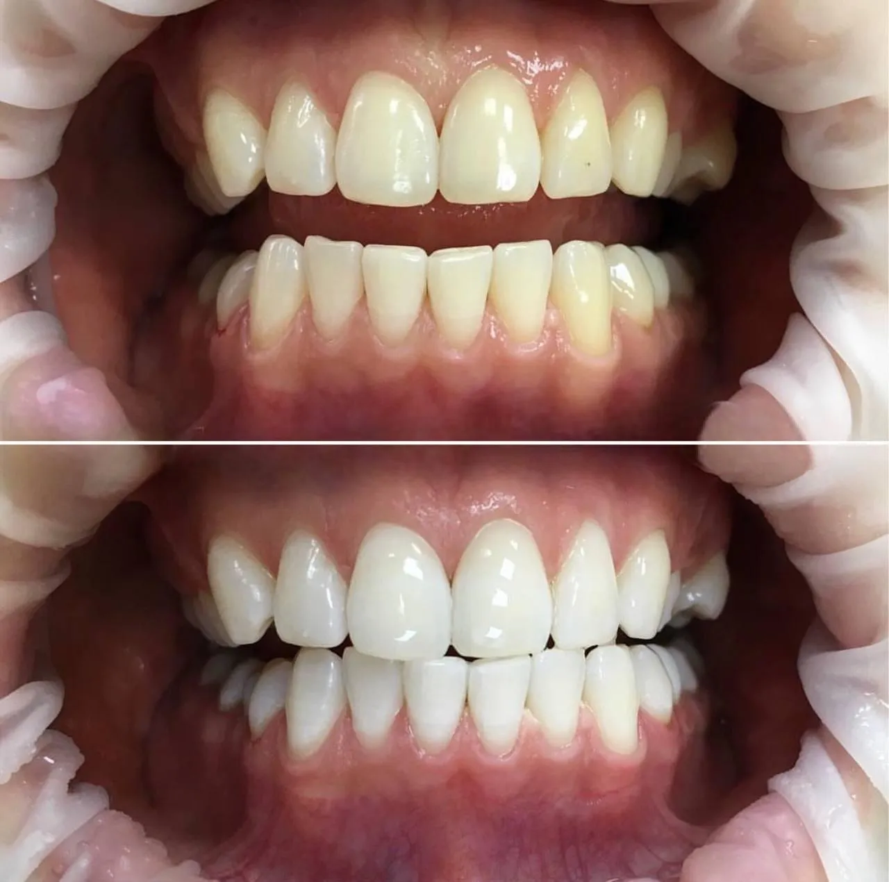 29892 miami beach teeth whitening 3