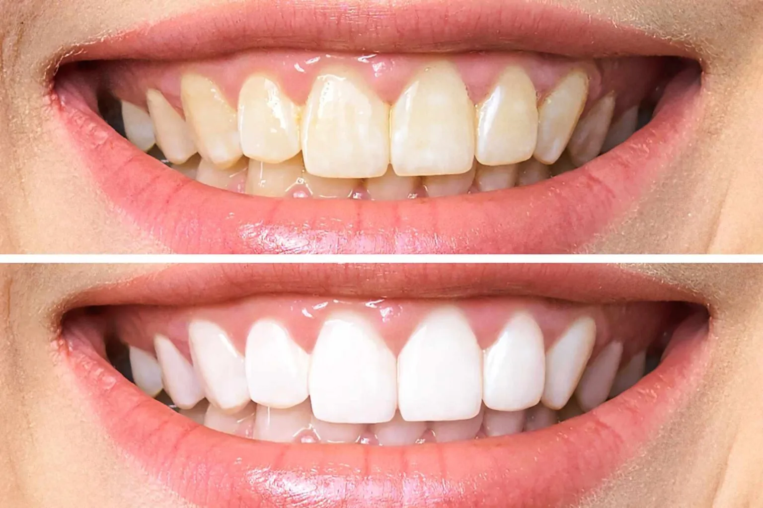 29892 miami beach teeth whitening 4