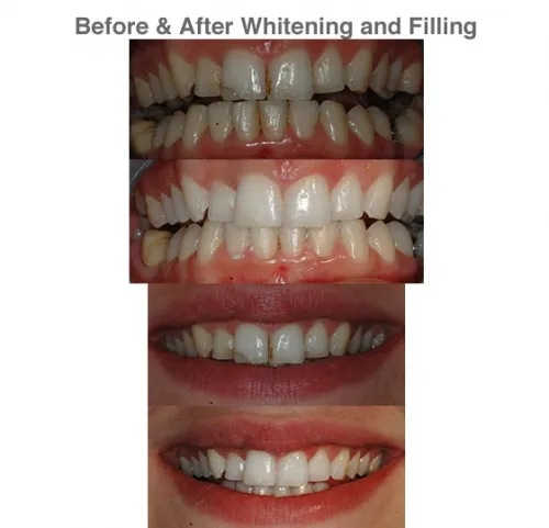 29894 teeth whitening treatment