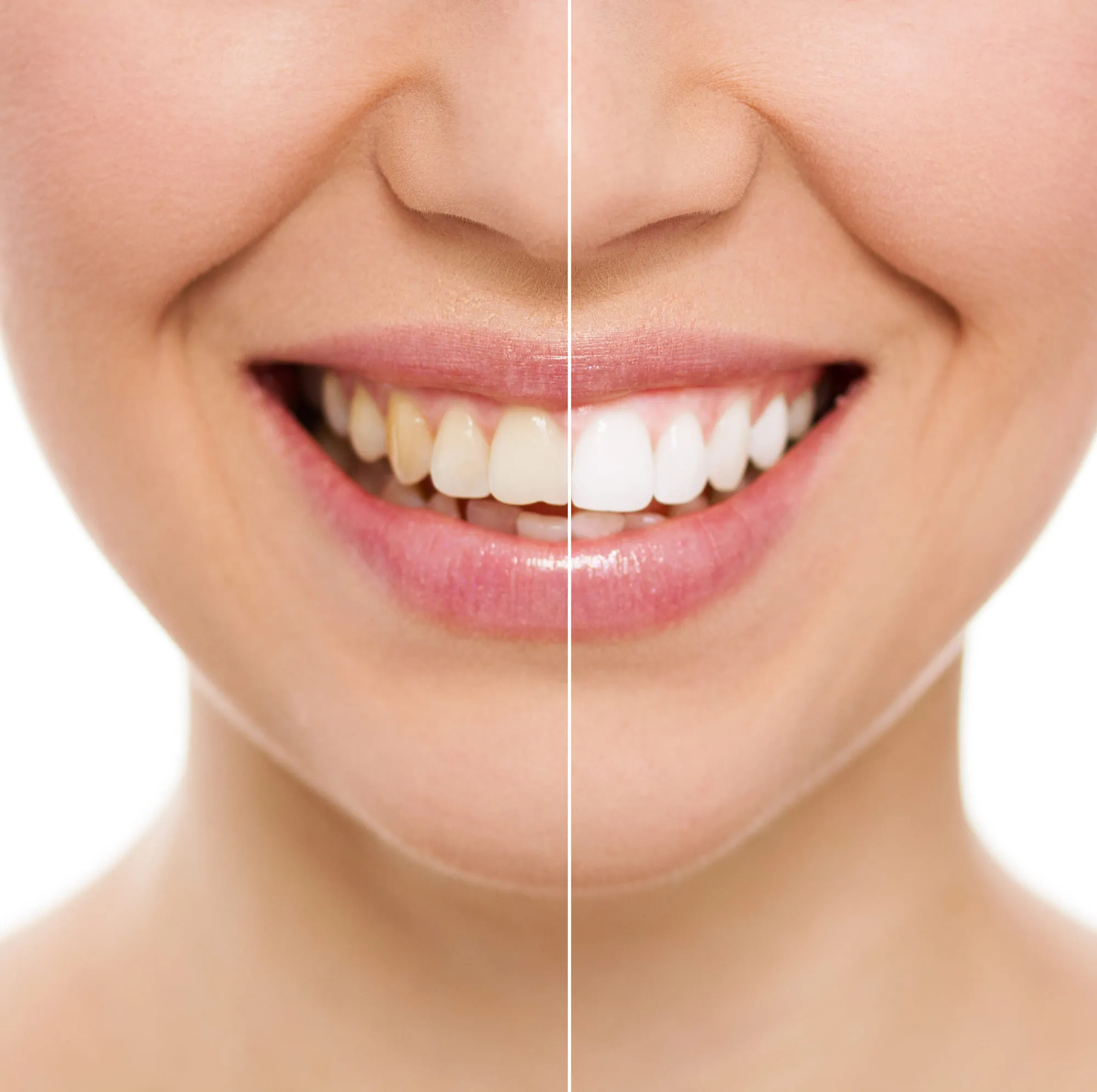 /img/29894-veneers-options.webp