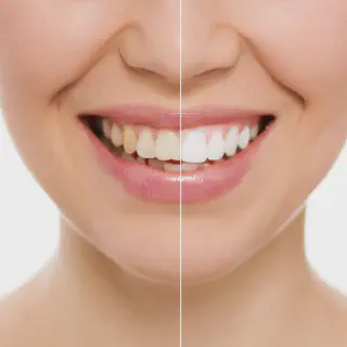 /img/29894-veneers-options.webp
