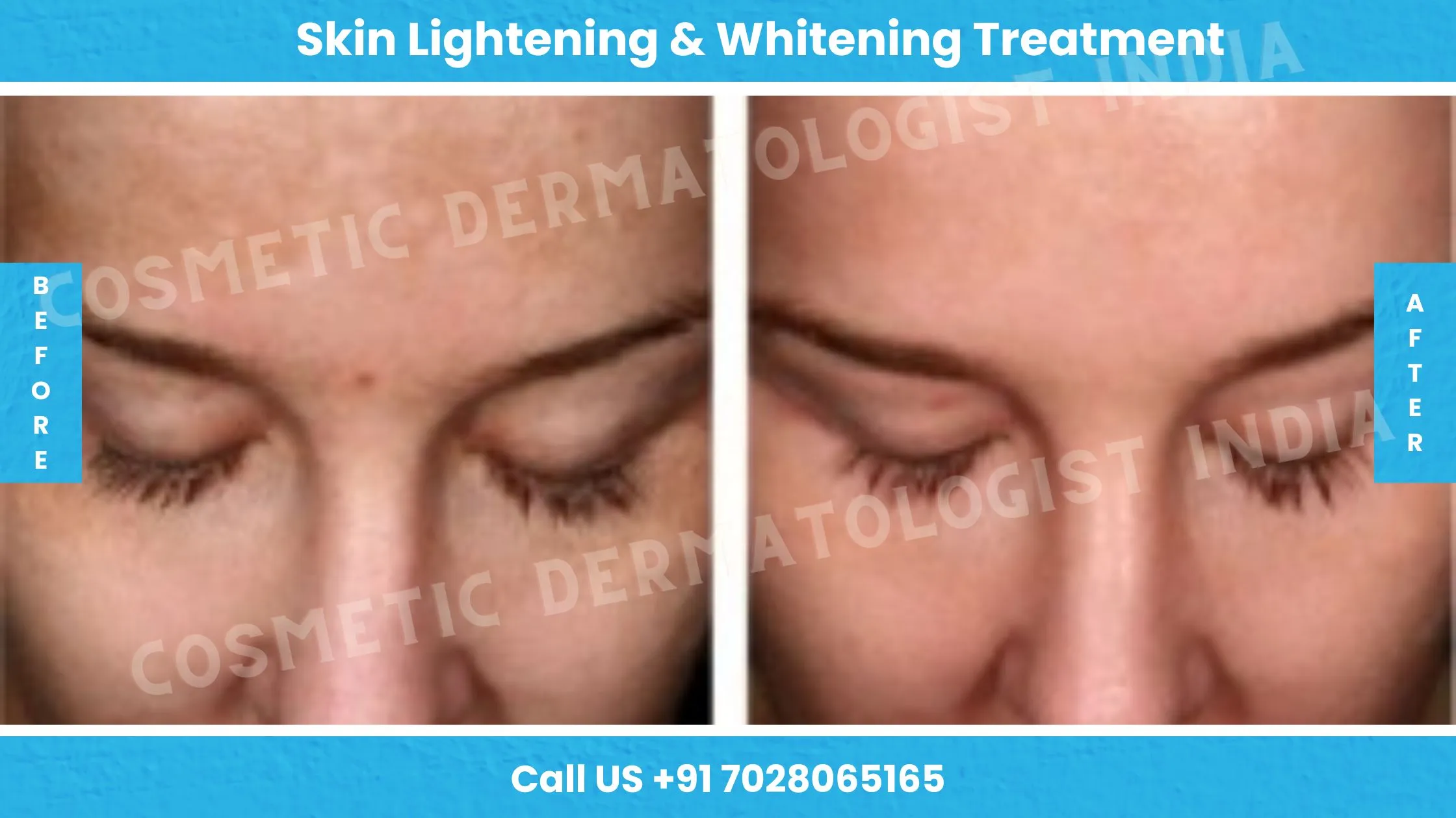 29896 skin whitening laser mumbai 1