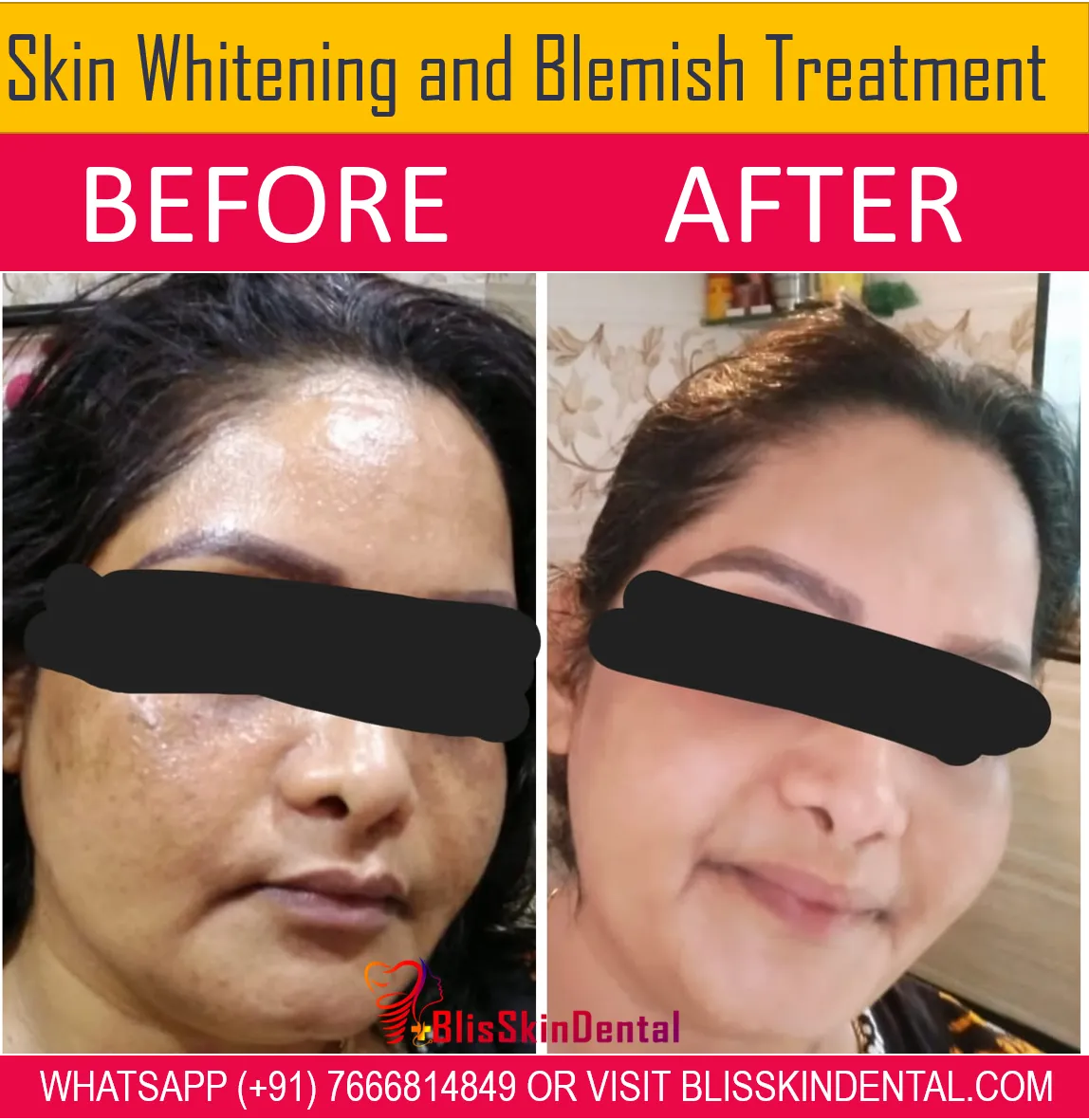 29896 skin whitening laser mumbai 4