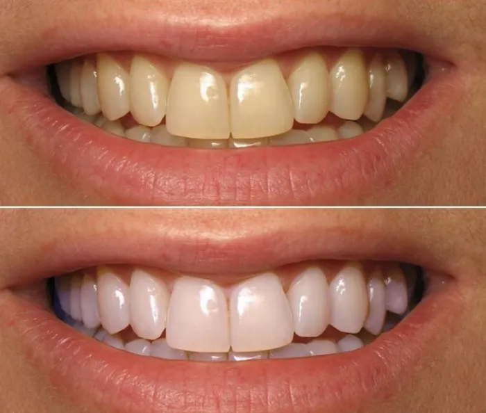29899 whitening strips overview