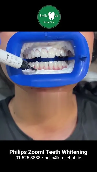 29905 smile hub whitening beautiful smile