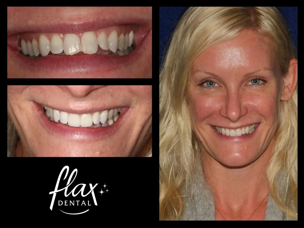 29911 at home teeth whitening atlanta