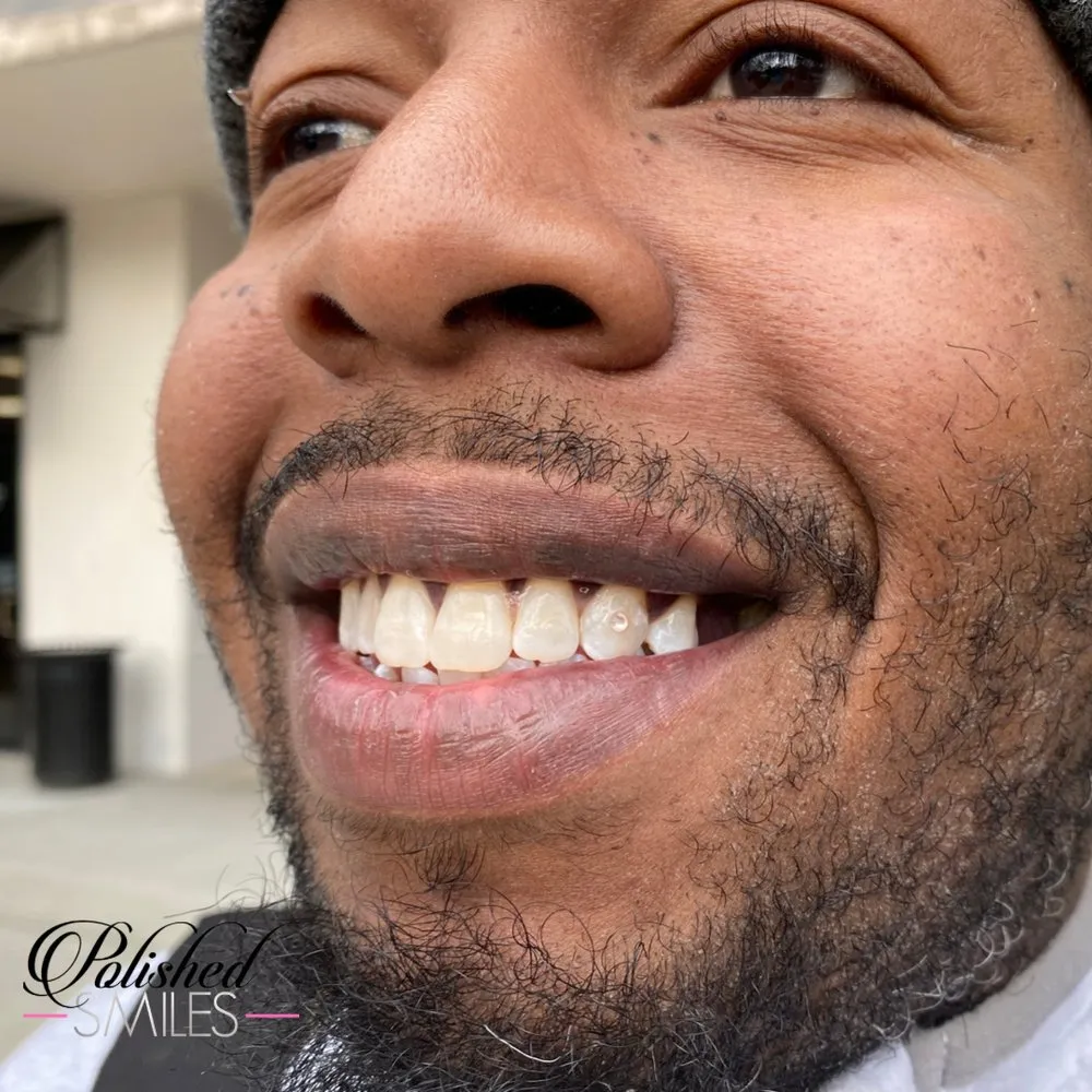 29911 custom fit trays