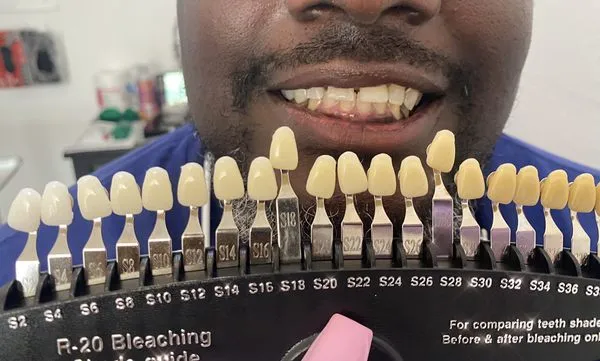 29911 in office teeth whitening atlanta