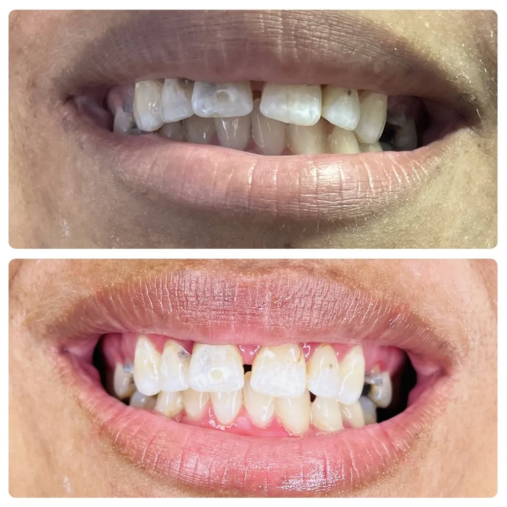 29911 teeth whitening strips