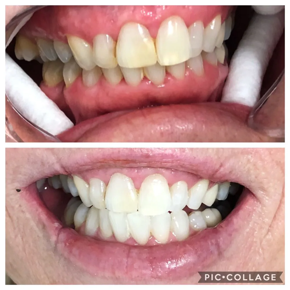 29911 whitening toothpaste brands