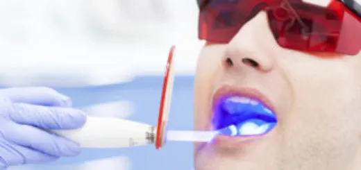 29912 laser teeth whitening results