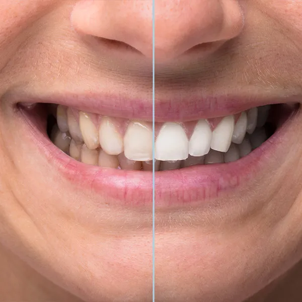 29915 teeth whitening lake charles before after