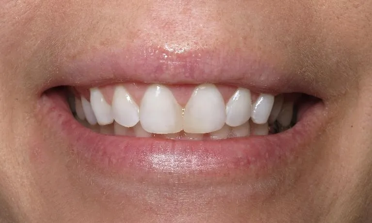 29915 teeth whitening lake charles maintenance tips