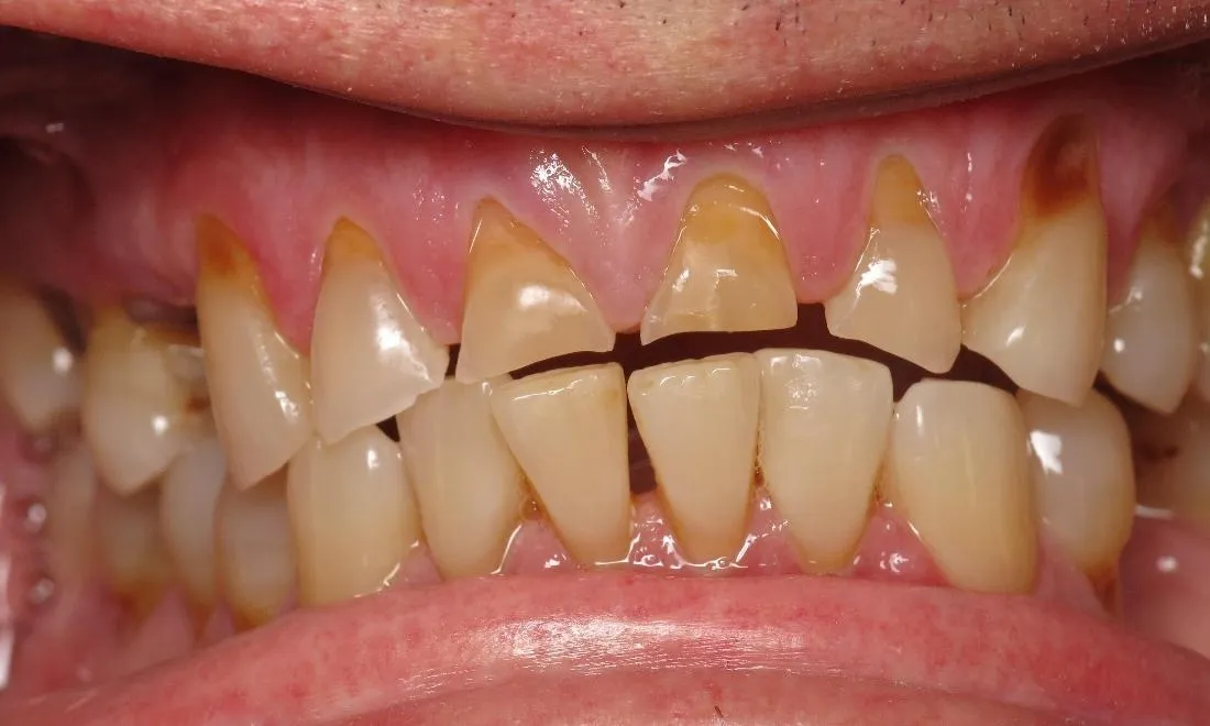 29915 teeth whitening lake charles oral hygiene