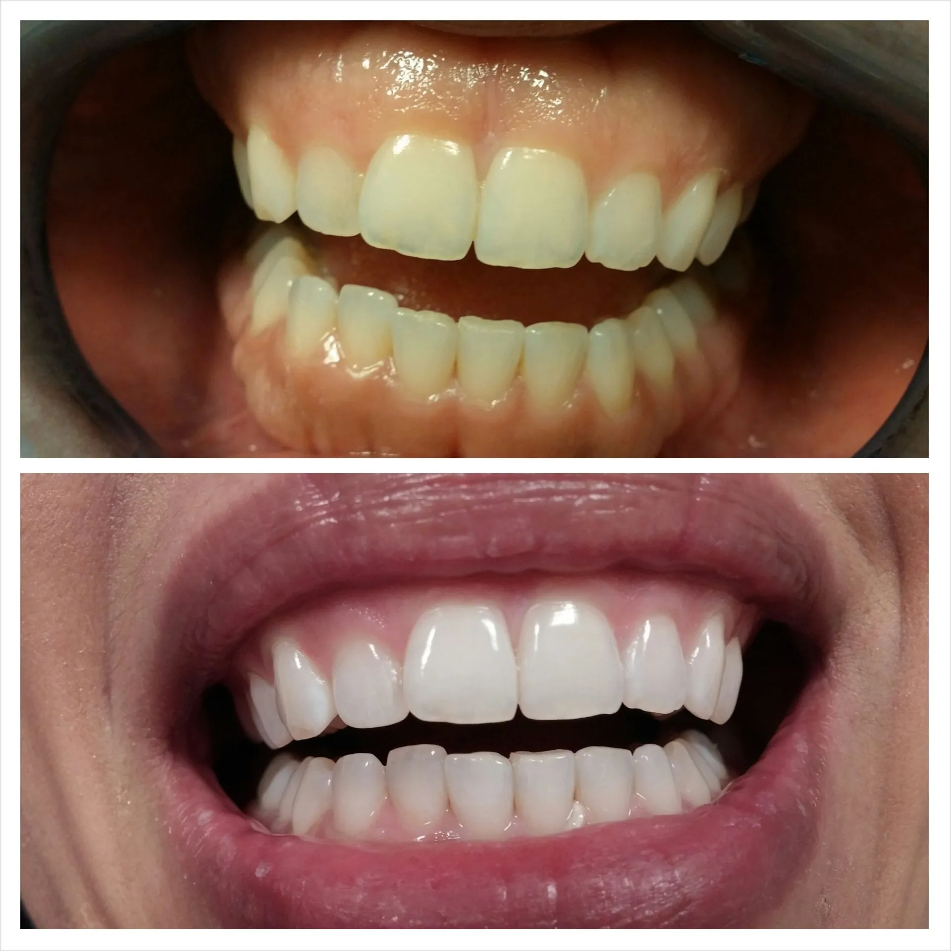 29919 teeth whitening surgery consultation