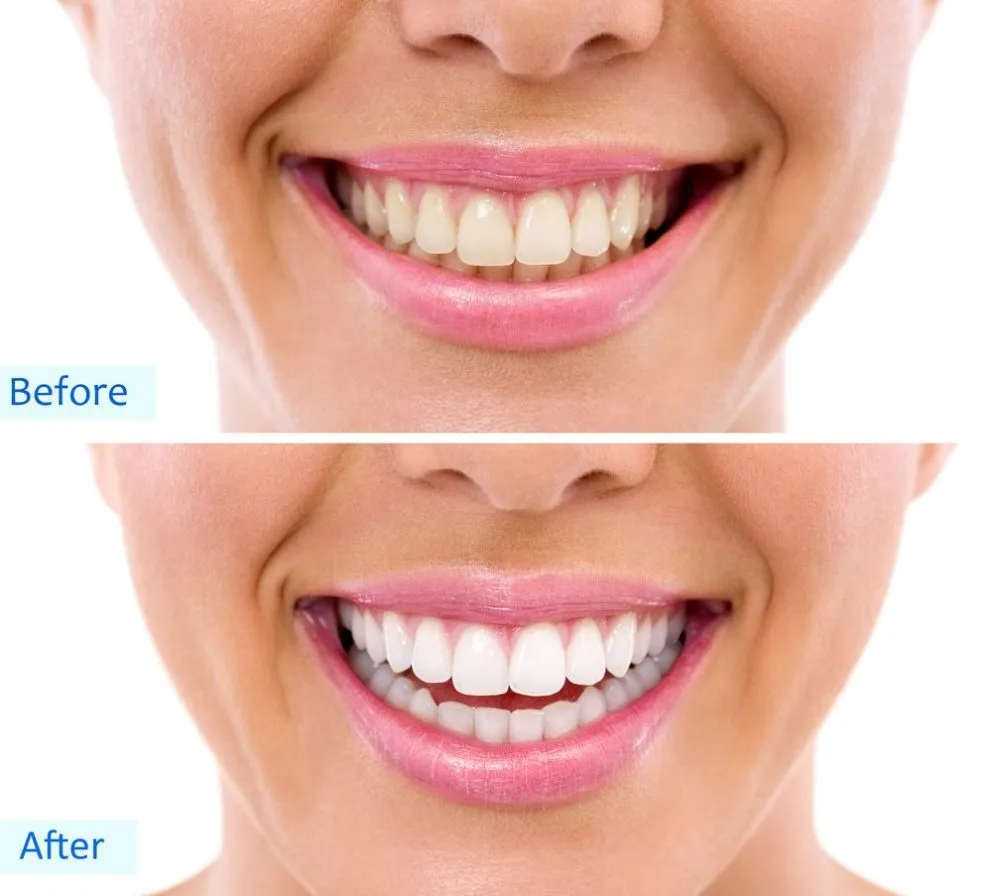 29919 teeth whitening surgery in office